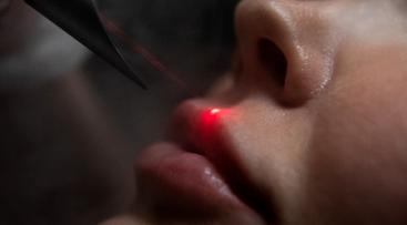 Лазерное омоложение губ Fotona Smooth lips в Краснодаре