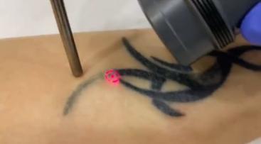 Лазерное удаление татуировок в Краснодаре