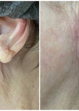 Коррекция околоушных морщин и мочки уха