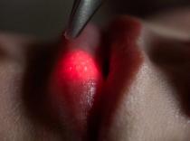 Лазерное лечение губ в Краснодаре