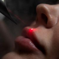 Лазерное омоложение губ Fotona Smooth lips в Краснодаре